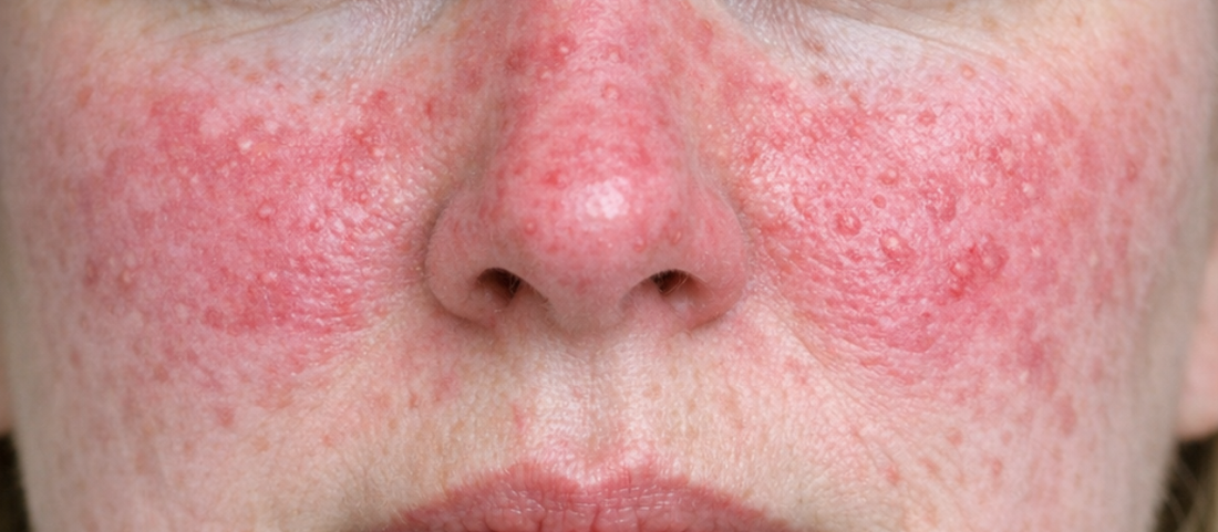 How to Formulate with Azelaic Acid