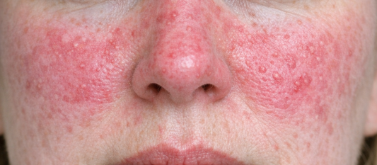 How to Formulate with Azelaic Acid